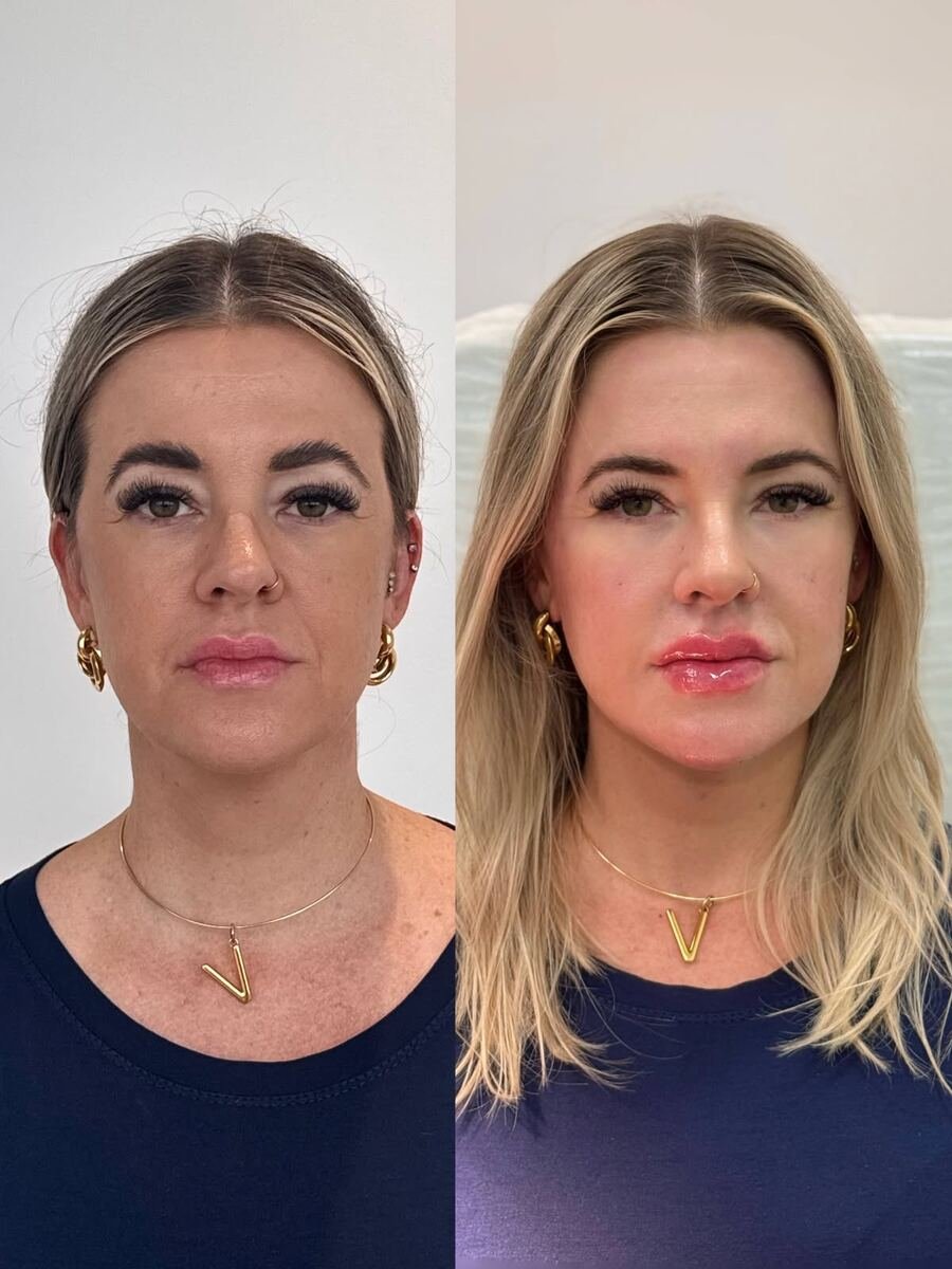 Antes e depois - transformação facial