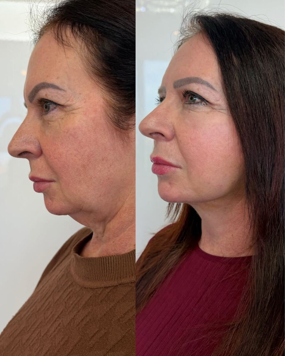Antes e depois - transformação facial